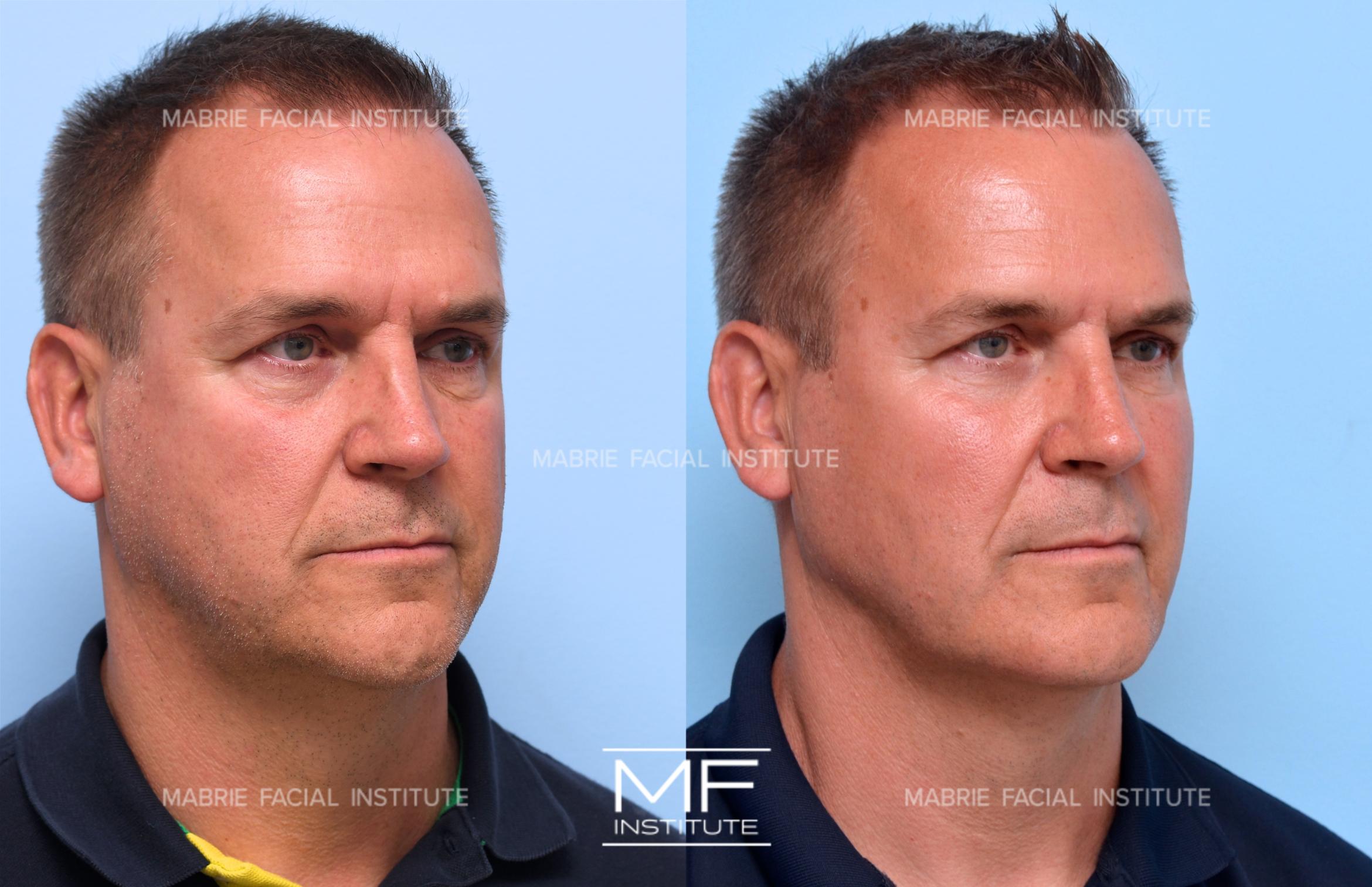 Before & After i360 Non Surgical Facelift Case 1423 Right Oblique View in San Francisco, CA
