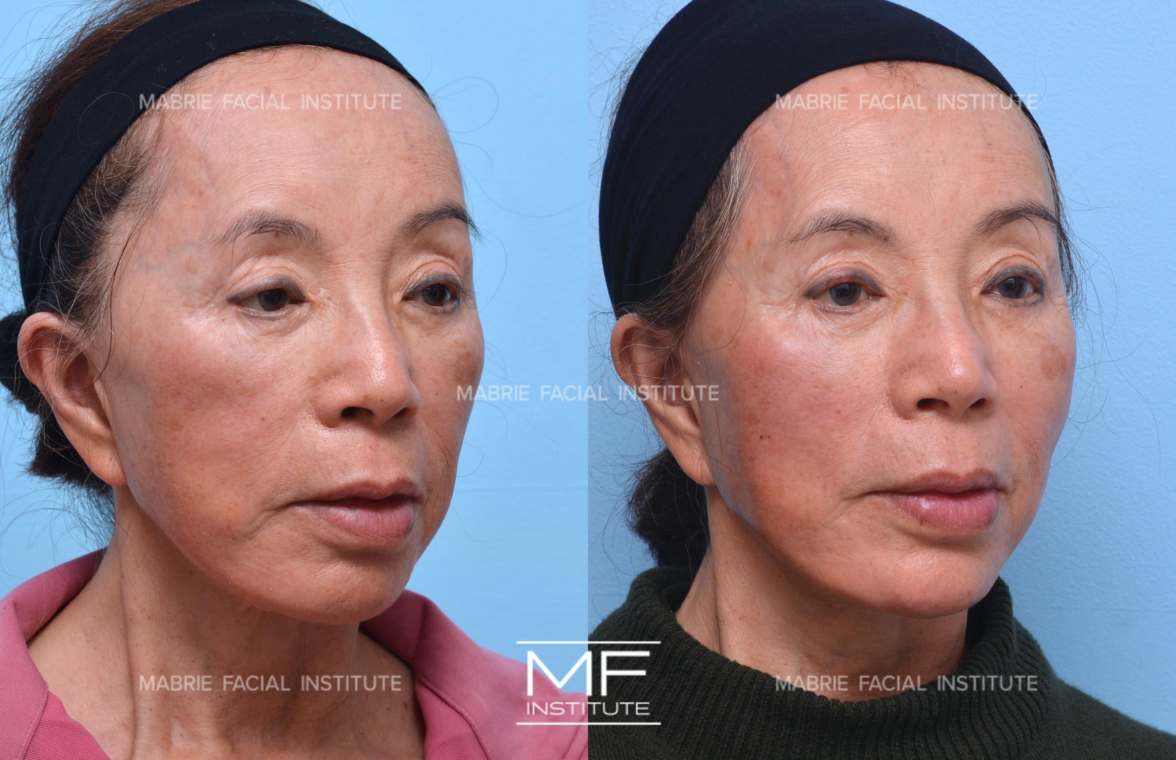 Before & After i360 Non Surgical Facelift Case 1429 Right Oblique View in San Francisco, CA
