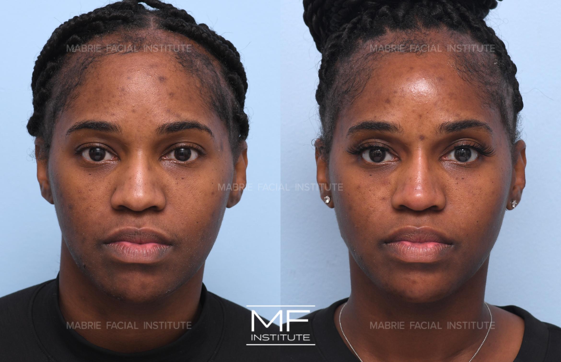 BOTOX® & Fillers for the Round Face Before and After Pictures Case 775 ...