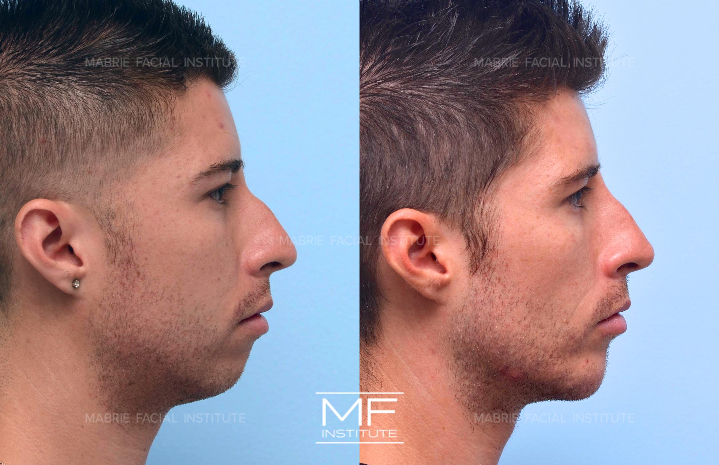 Before & After Chin Projection Case 496 View #1 View in San Francisco, CA