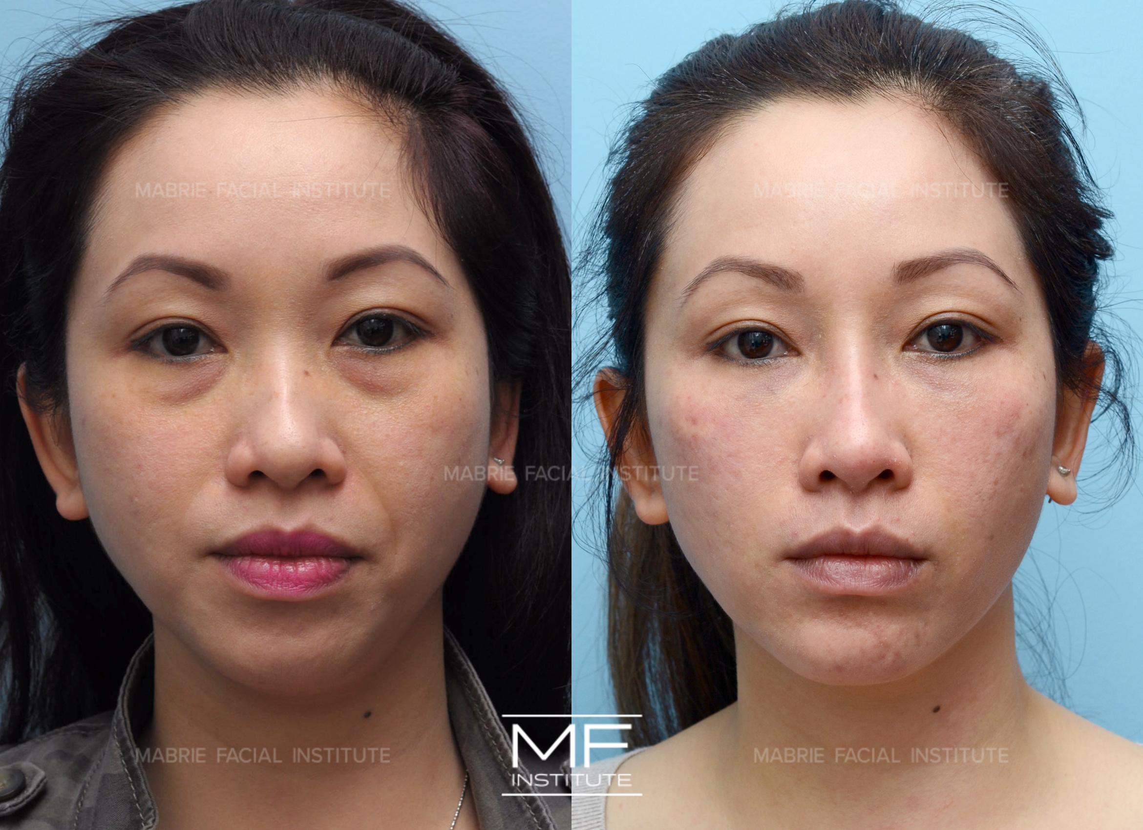 Before & After Complete Facial Rejuvenation or Contouring Case 375 View #1 View in San Francisco, CA