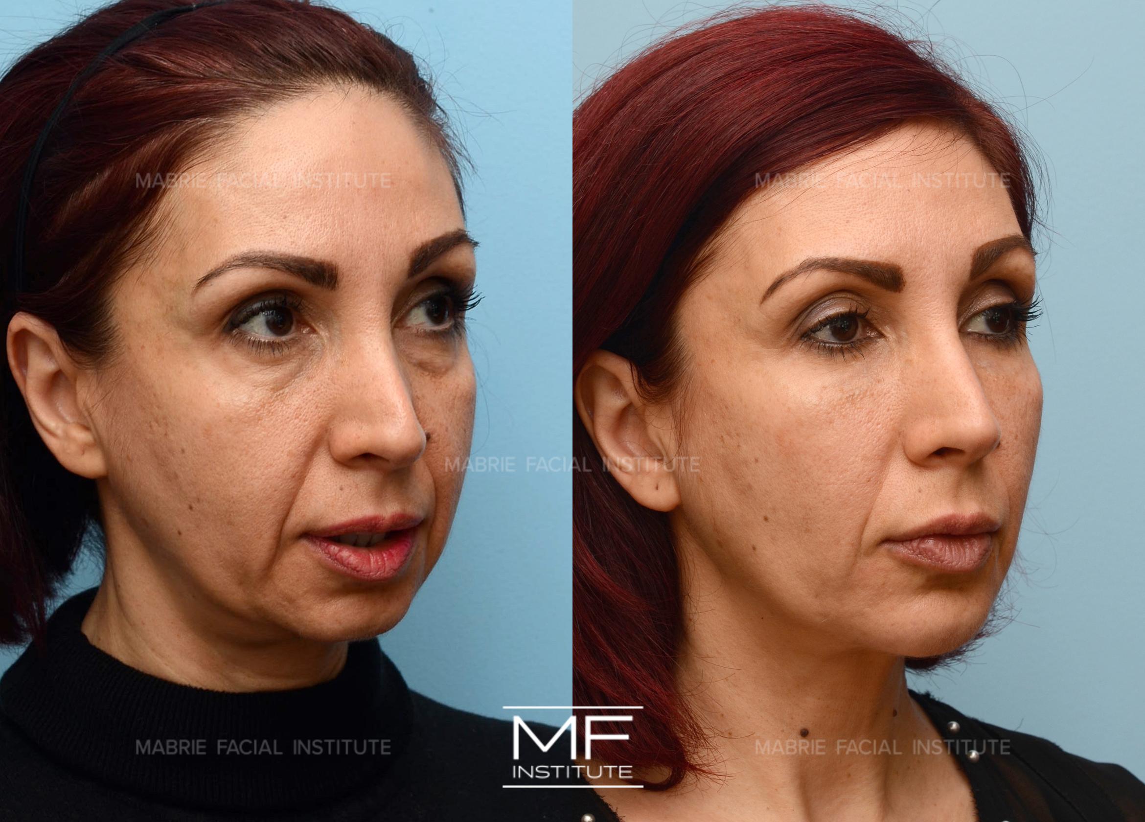 Before & After Complete Facial Rejuvenation or Contouring Case 401 View #1 View in San Francisco, CA