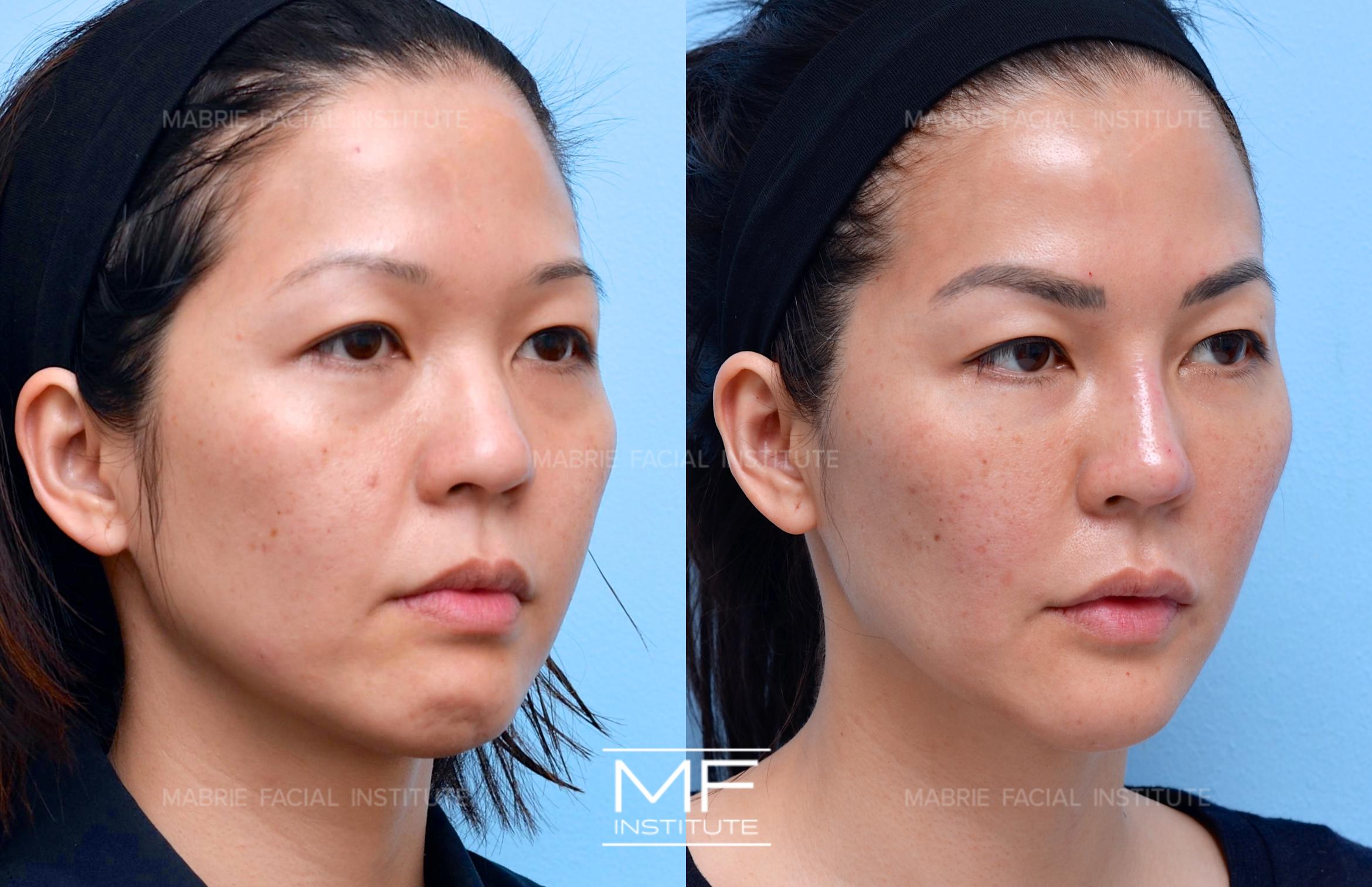 Before & After Complete Facial Rejuvenation or Contouring Case 607 View #1 View in San Francisco, CA