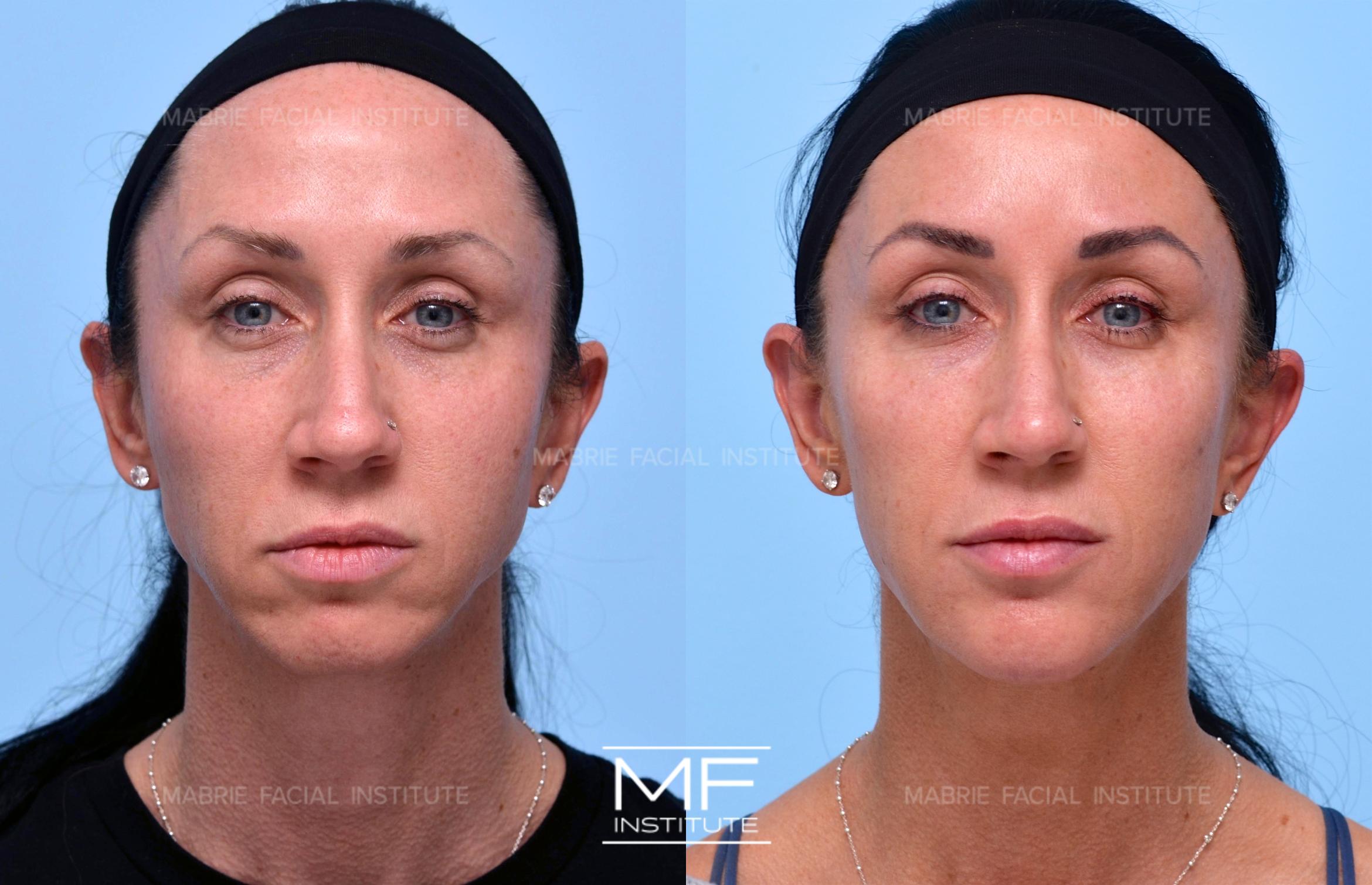 Before & After Complete Facial Rejuvenation or Contouring Case 624 View #1 View in San Francisco, CA