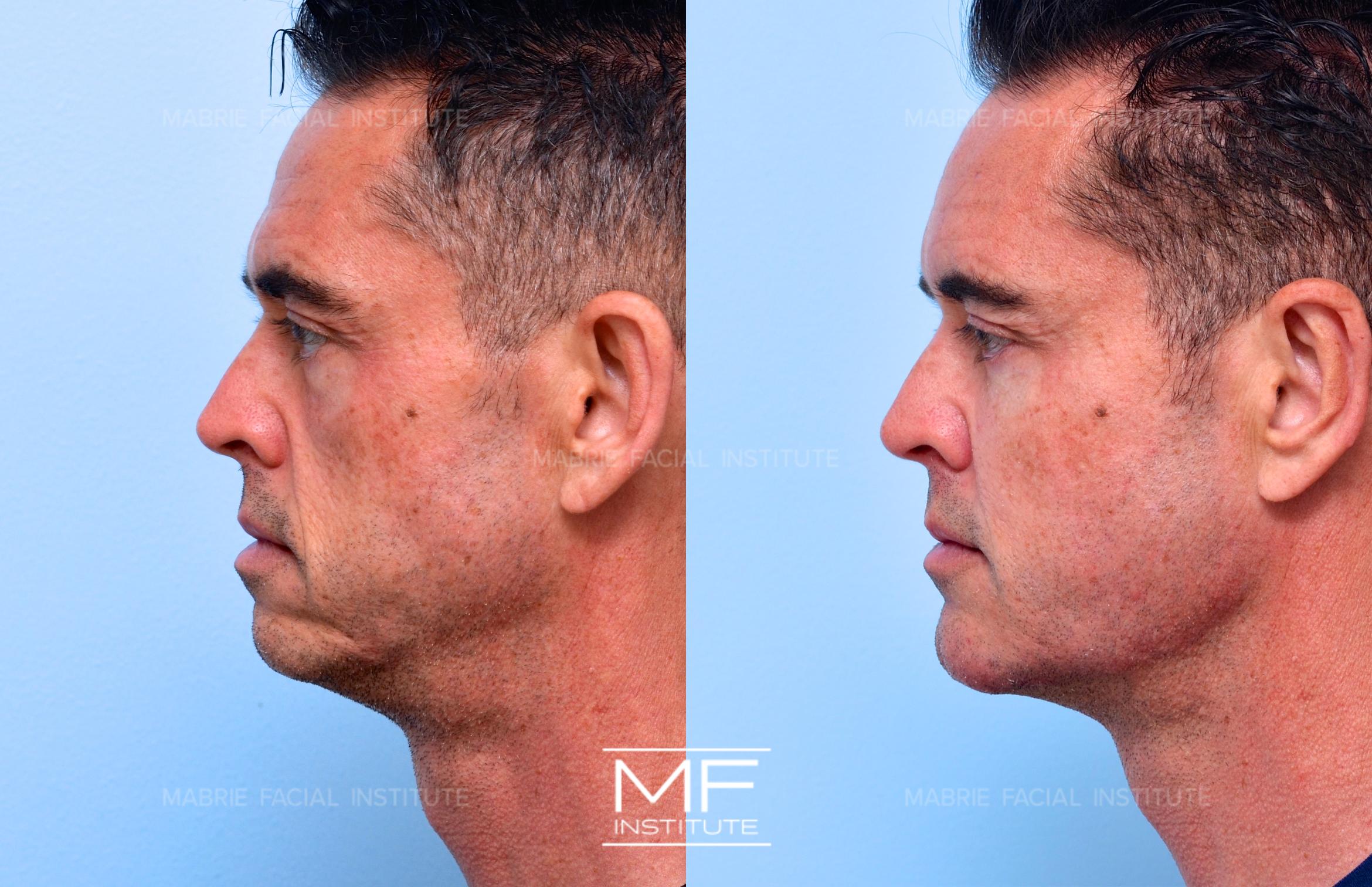 Before & After Complete Facial Rejuvenation or Contouring Case 645 View #1 View in San Francisco, CA