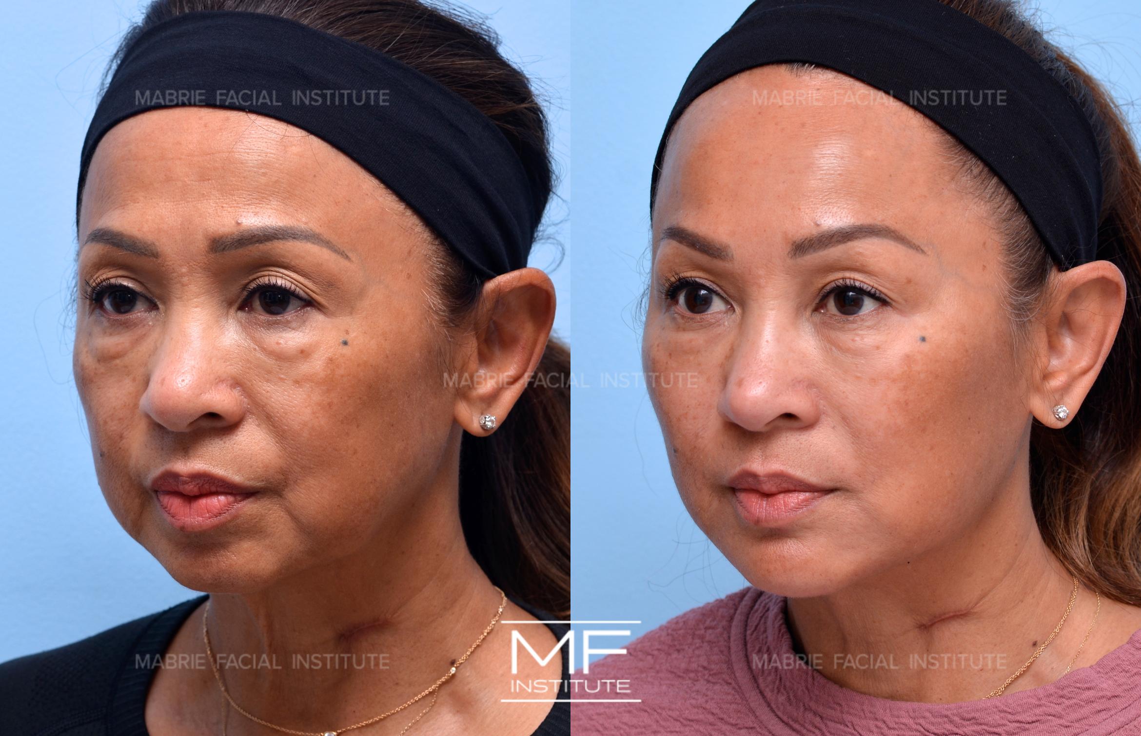 Before & After Complete Facial Rejuvenation or Contouring Case 735 View #1 View in San Francisco, CA