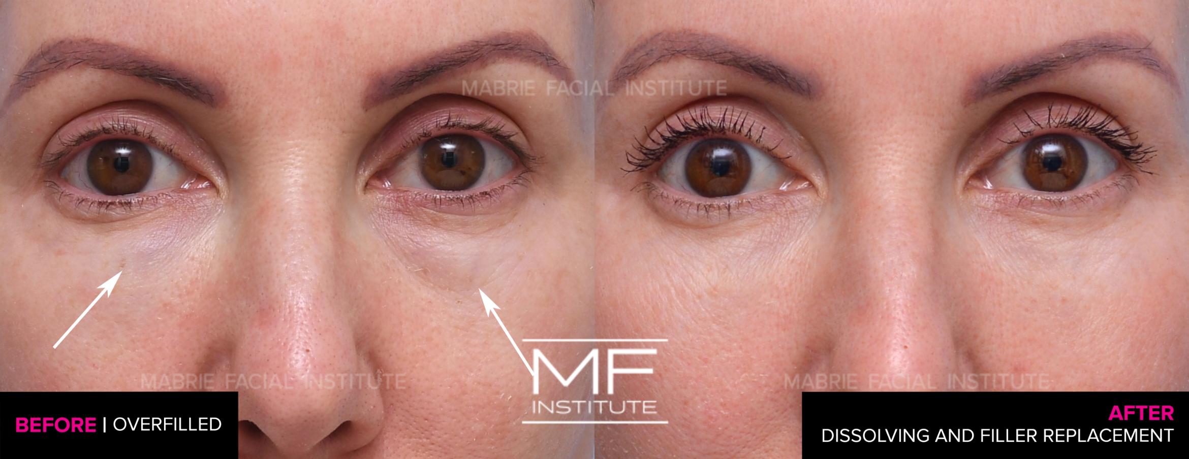 Before & After Correcting Previous Under Eye Filler Case 837 View #1 View in San Francisco, CA