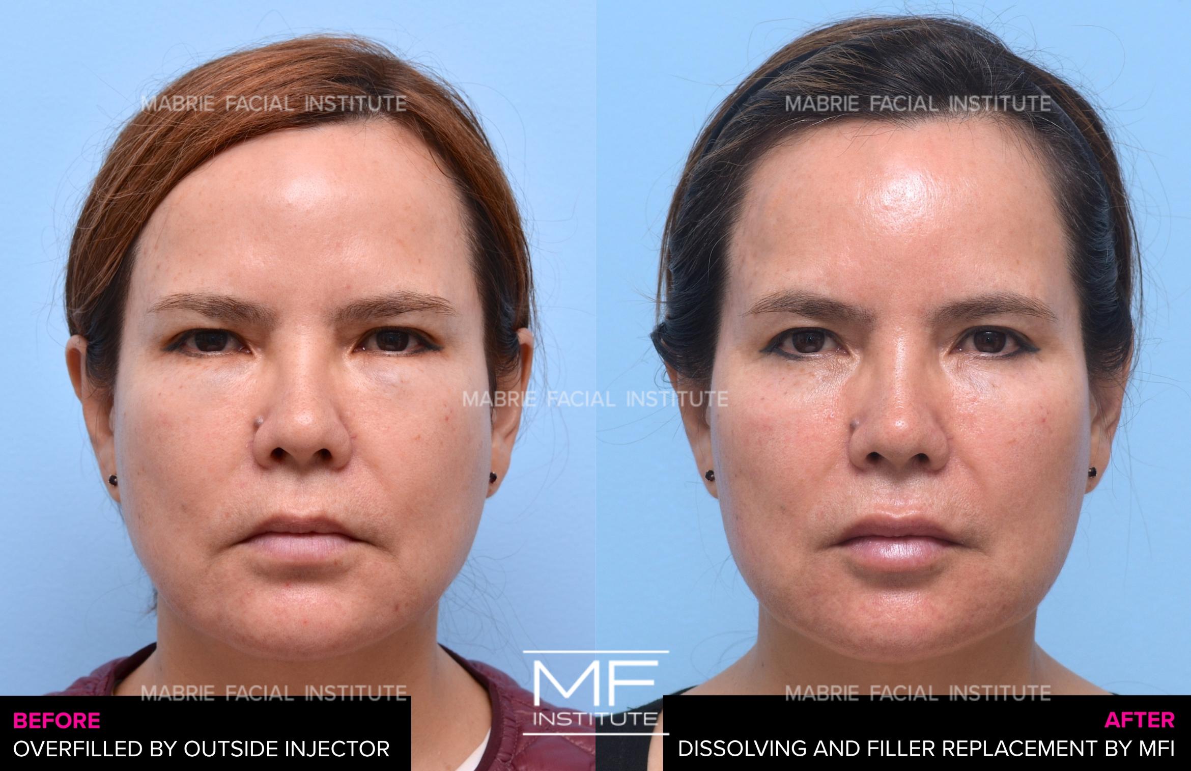 Before & After Corrective Injections Case 1405 Front View in San Francisco, CA