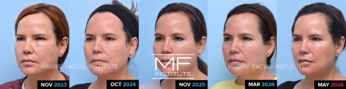 Corrective Injections Before and After Pictures Case 1405 | San ...