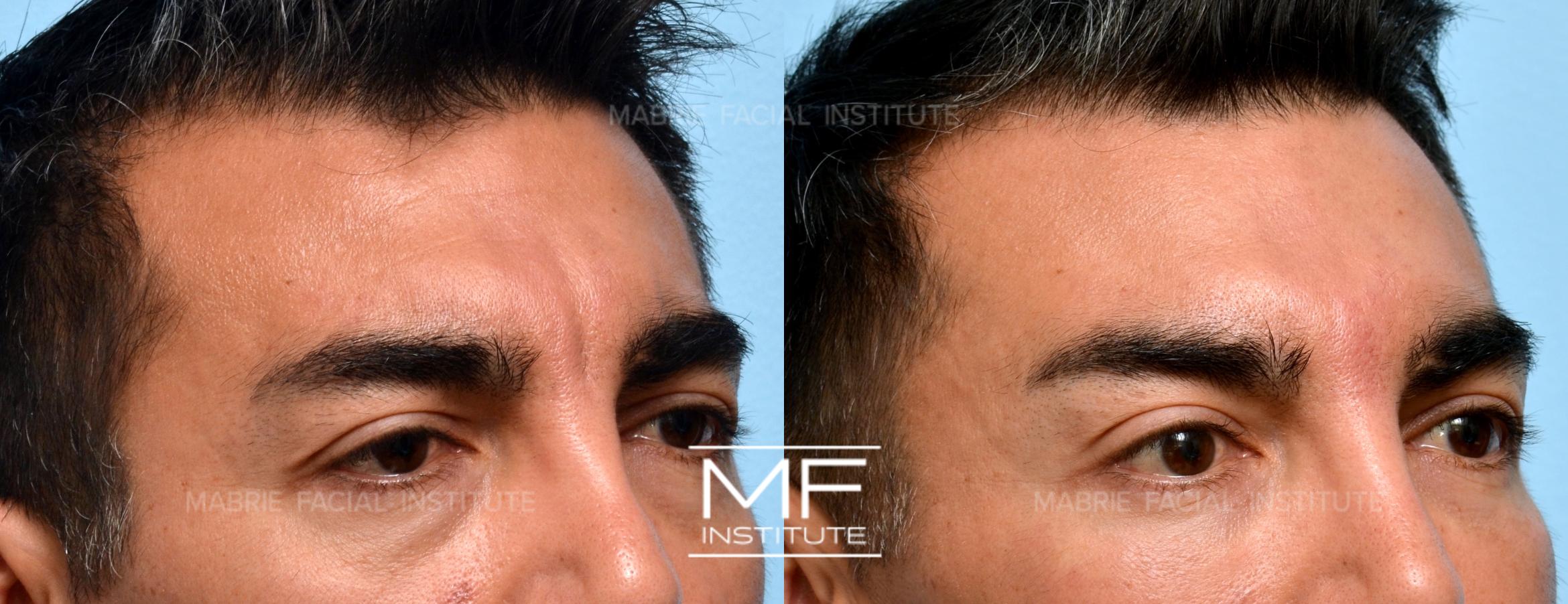 Before & After Drooping Brow Case 910 View #1 View in San Francisco, CA