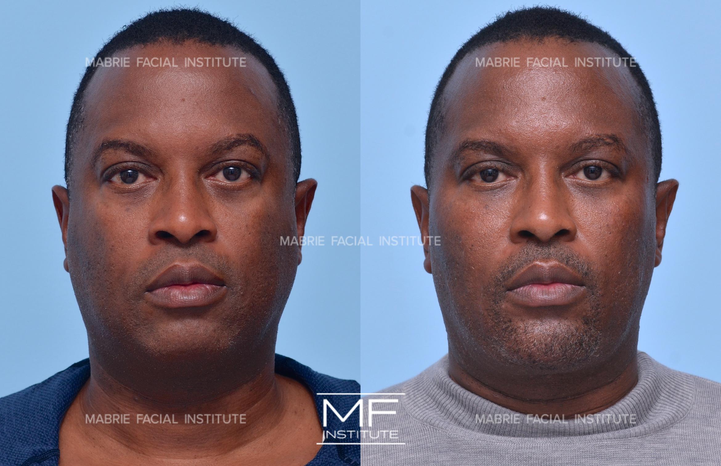 Before & After Facial Slimming Case 1289 Front View in San Francisco, CA