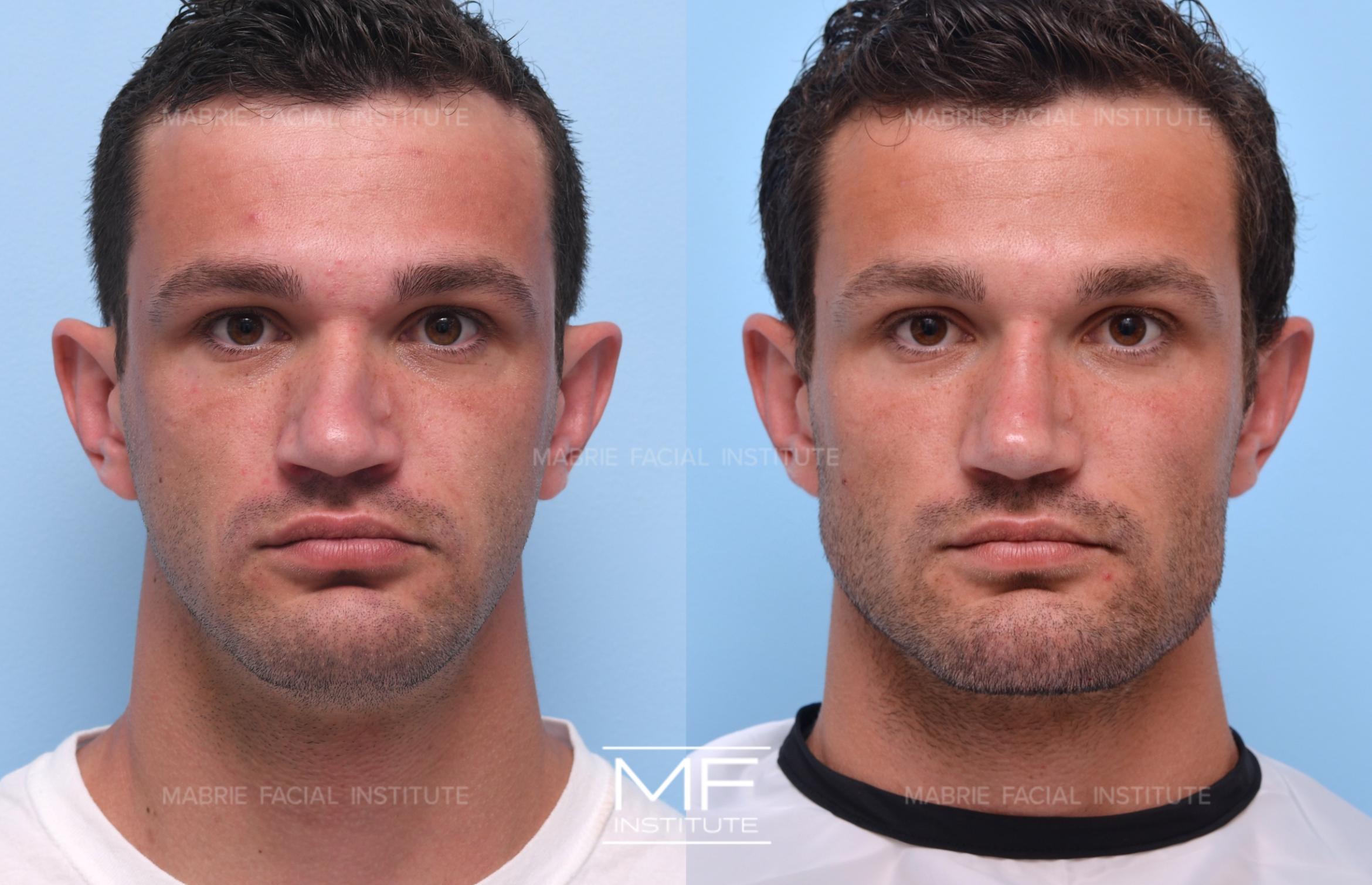 Before & After Jawline Definition Case 1193 View #1 View in San Francisco, CA