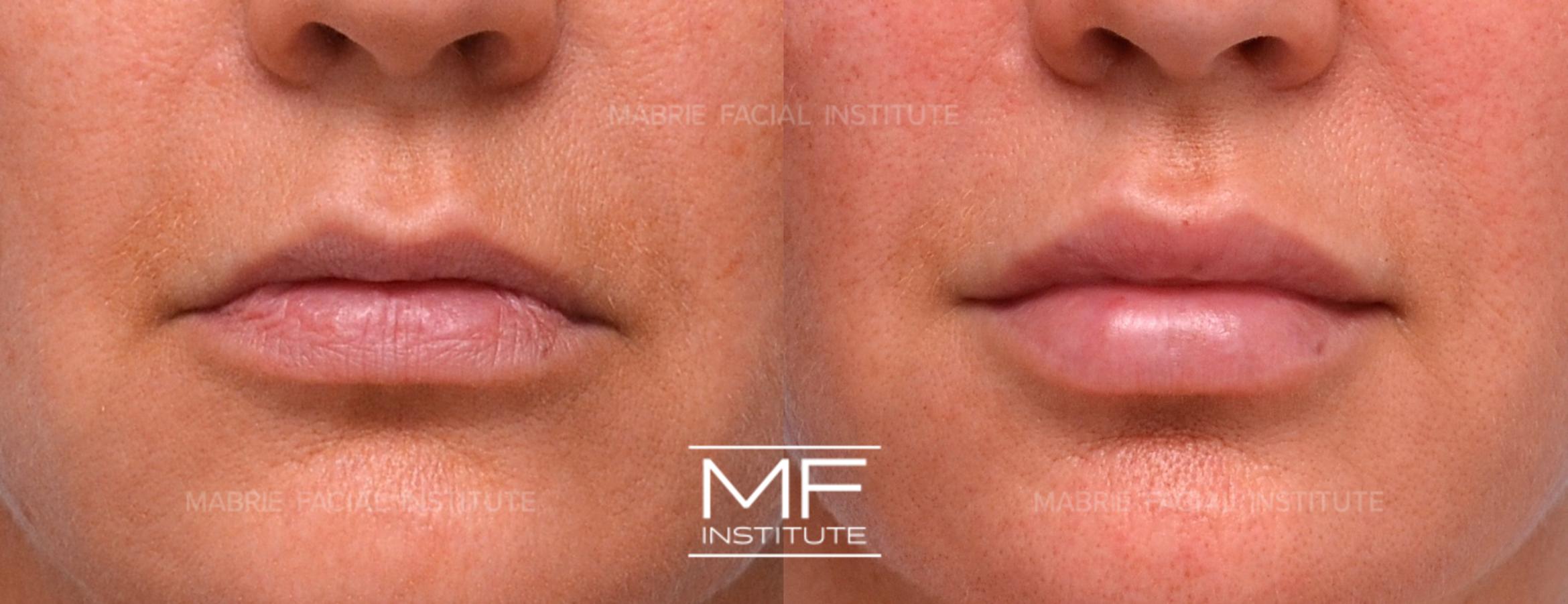 Before & After Lip Filler - Bold Case 917 View #1 View in San Francisco, CA