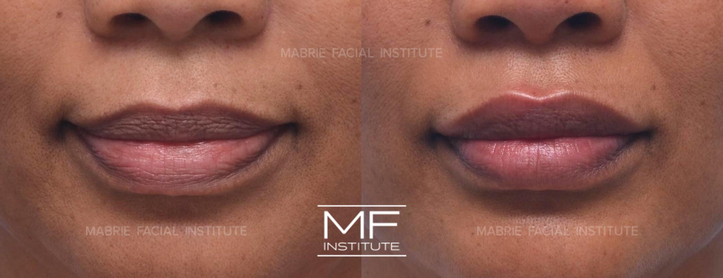 Before & After Lip Filler - Subtle Case 540 View #1 View in San Francisco, CA