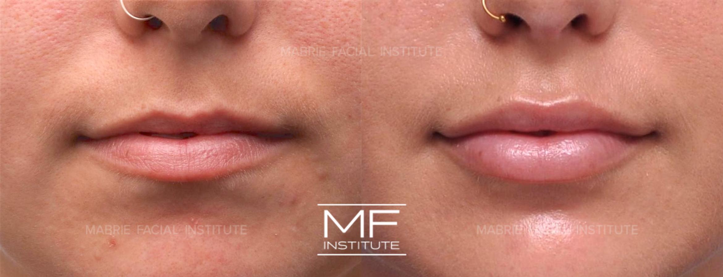 Before & After Lip Filler - Subtle Case 551 View #1 View in San Francisco, CA