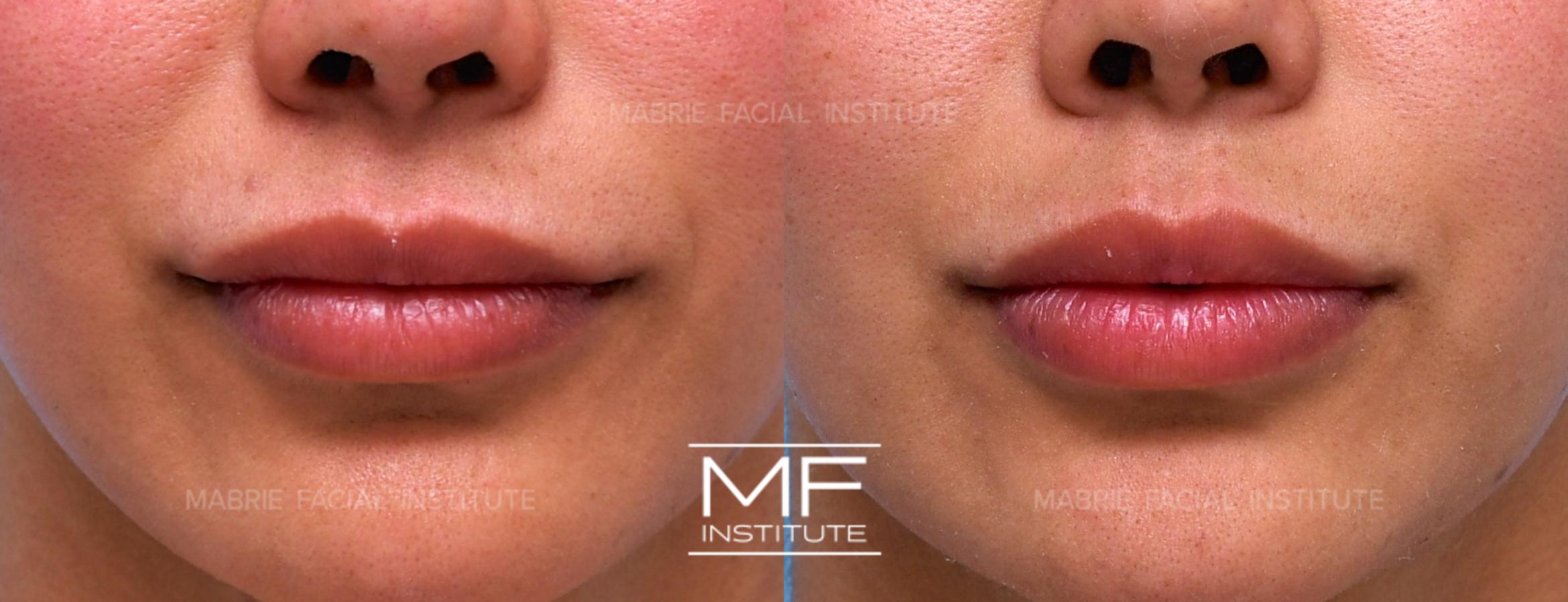 Before & After Lip Filler - Subtle Case 692 View #1 View in San Francisco, CA