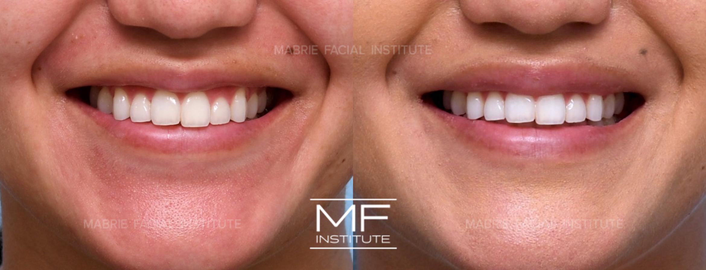 Before & After Lip Filler - Subtle Case 815 View #1 View in San Francisco, CA