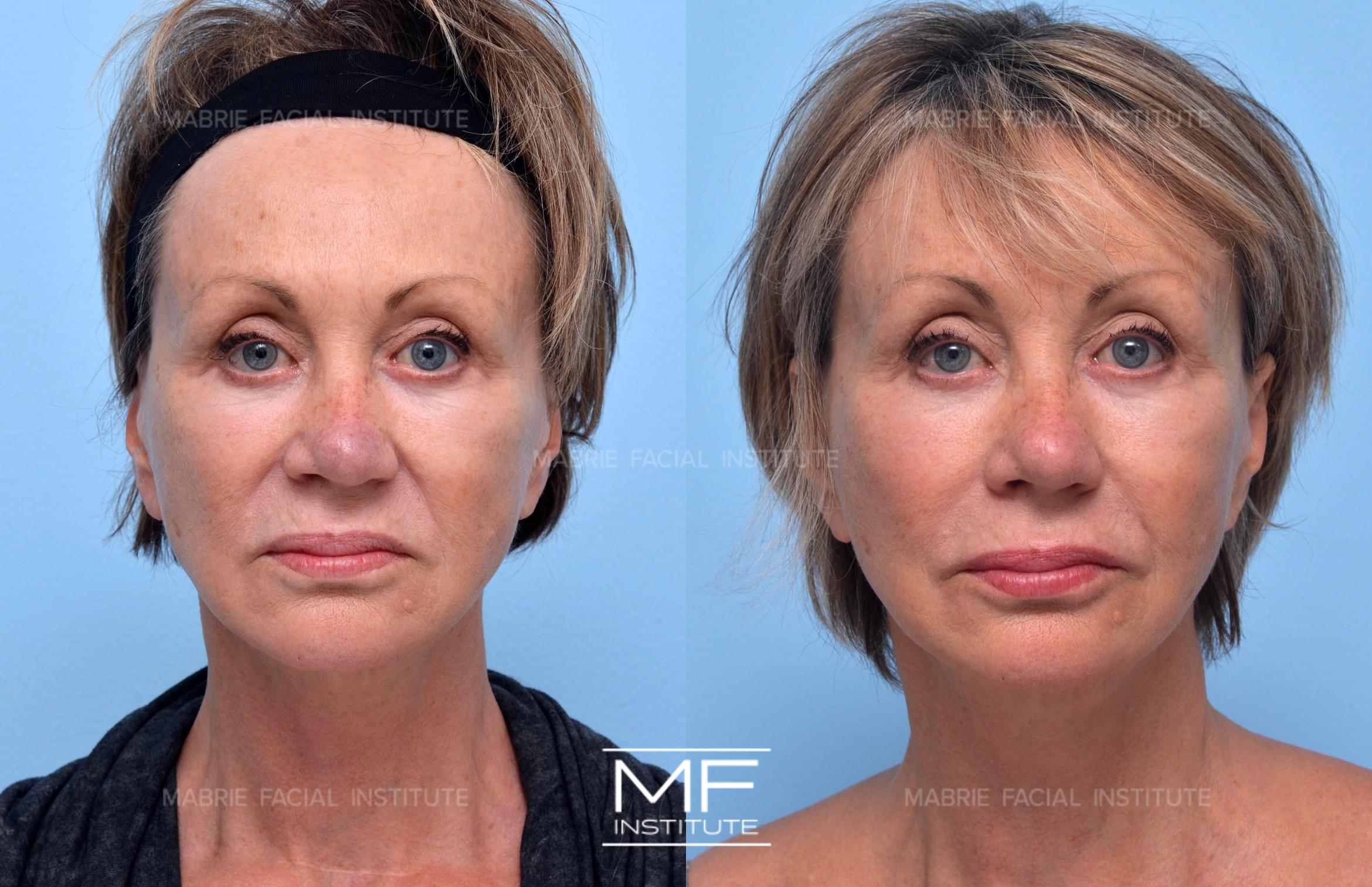 Before & After Nasolabial Folds Case 485 View #1 View in San Francisco, CA