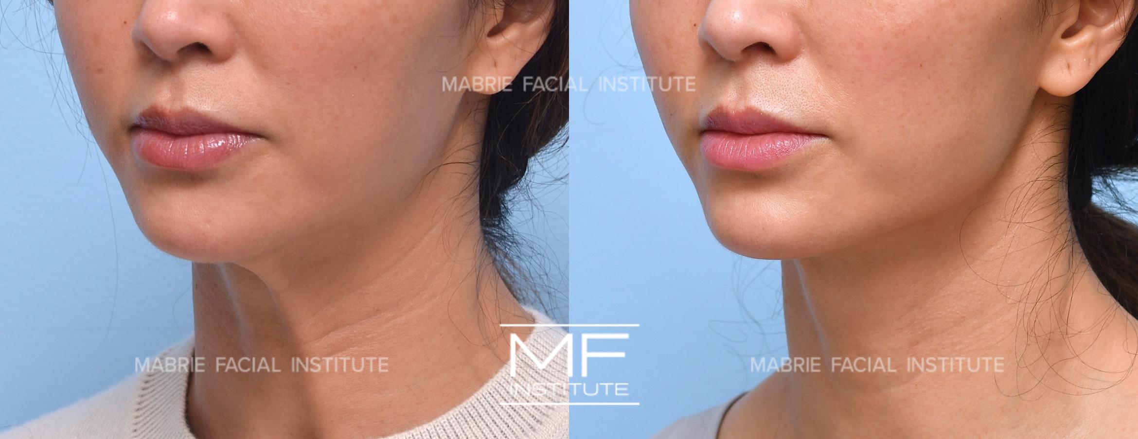 Before & After Neck Banding Case 1290 Left Oblique View in San Francisco, CA