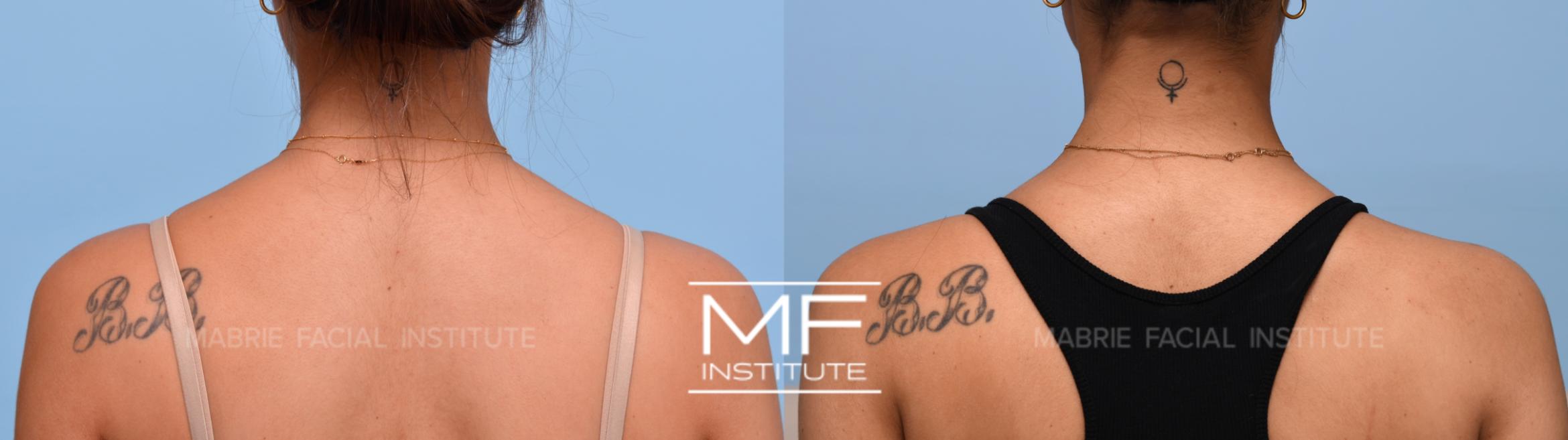 Before & After Neck Definition & Slimming  Case 1002 View #1 View in San Francisco, CA