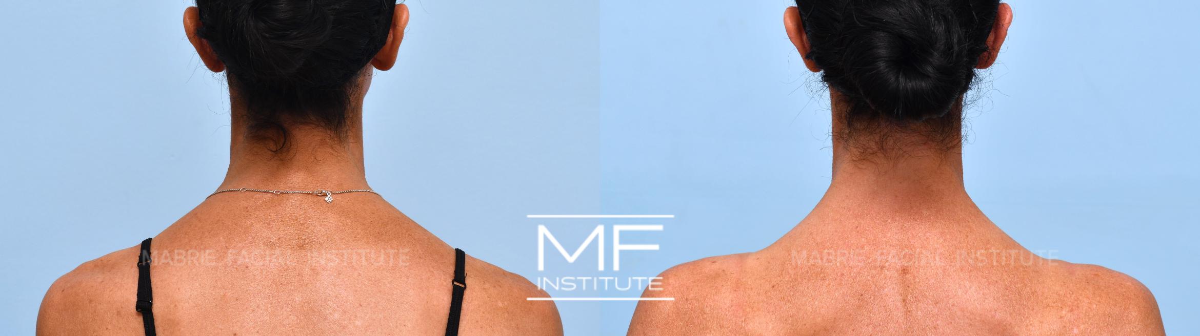 Before & After Neck Definition & Slimming  Case 1191 View #1 View in San Francisco, CA