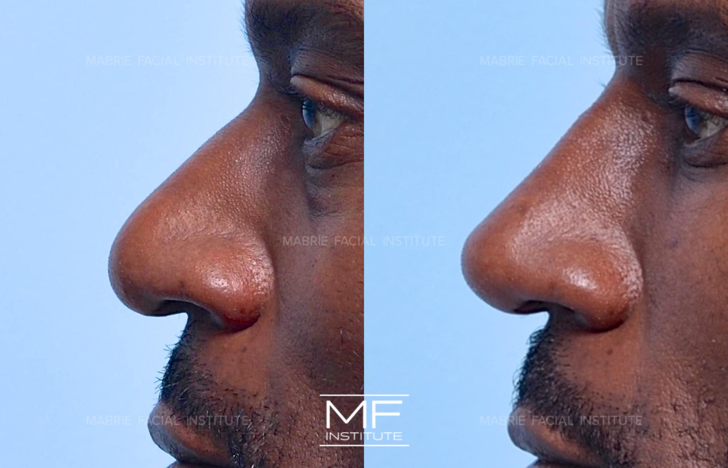 Before & After Non Surgical Rhinoplasty Case 1287 Left Side View in San Francisco, CA