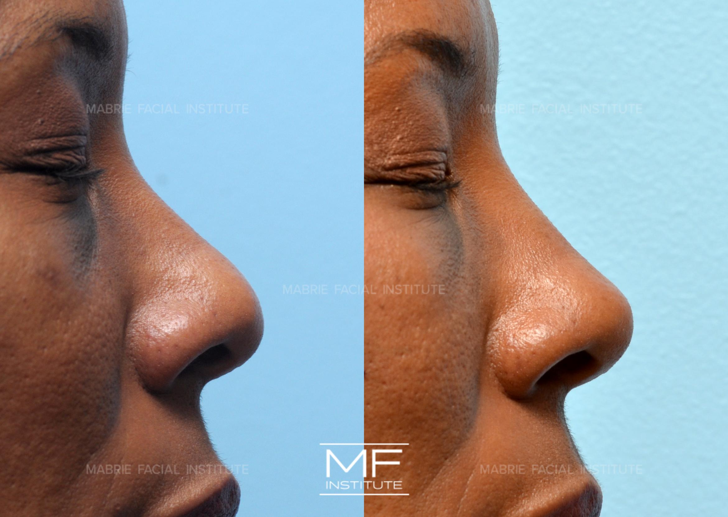 4 Ways To Make Your Nose Appear Smaller With Filler | Mabrie 