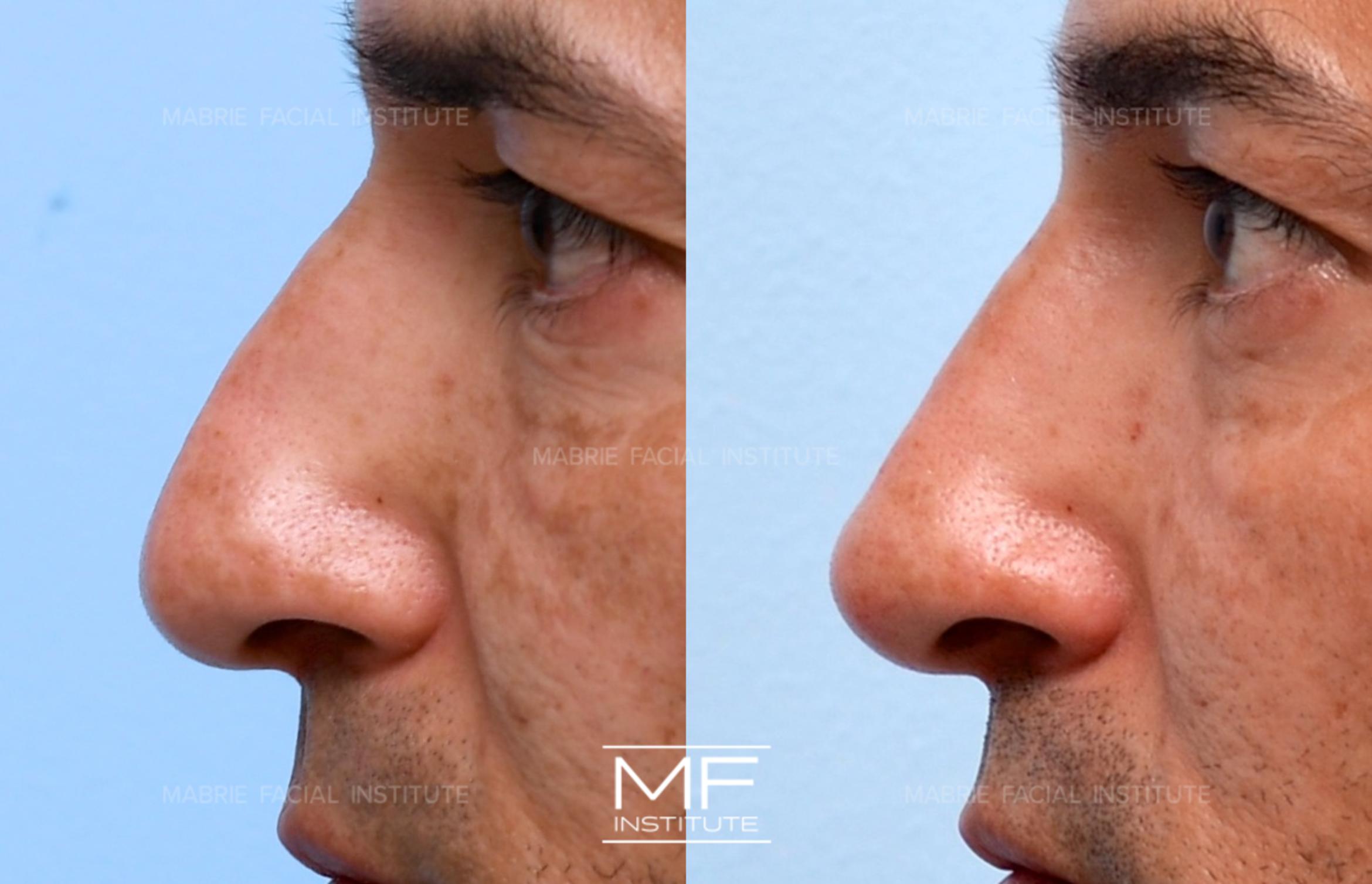 Before & After Non Surgical Rhinoplasty Case 680 View #1 View in San Francisco, CA