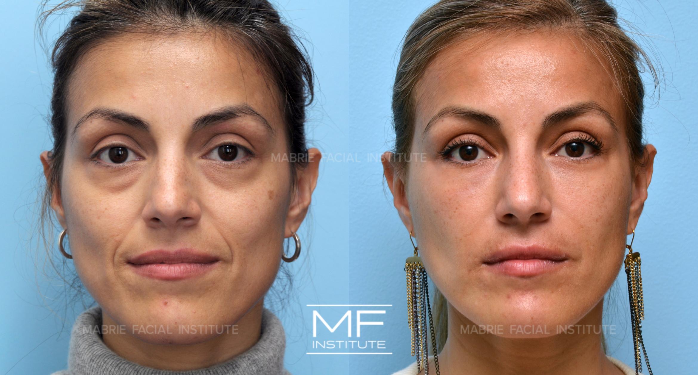 Before & After Under Eye Bags & Dark Circles Case 230 View #1 View in San Francisco, CA