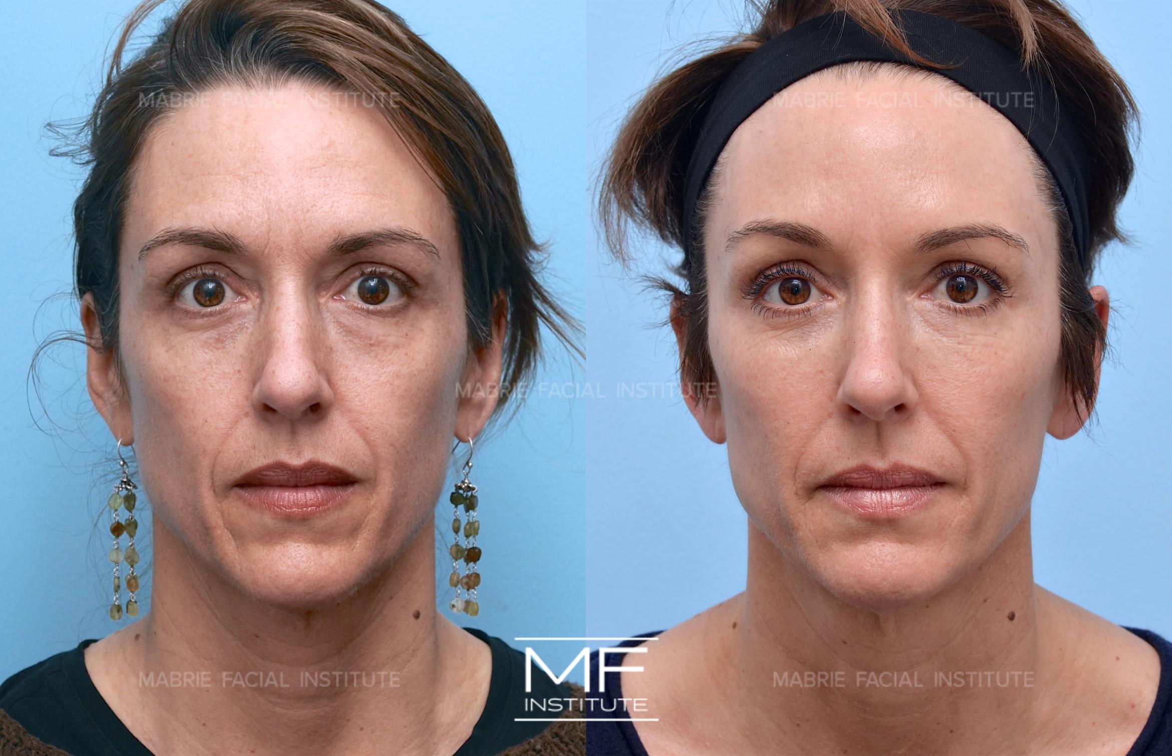 Before & After Under Eye Bags & Dark Circles Case 569 View #1 View in San Francisco, CA