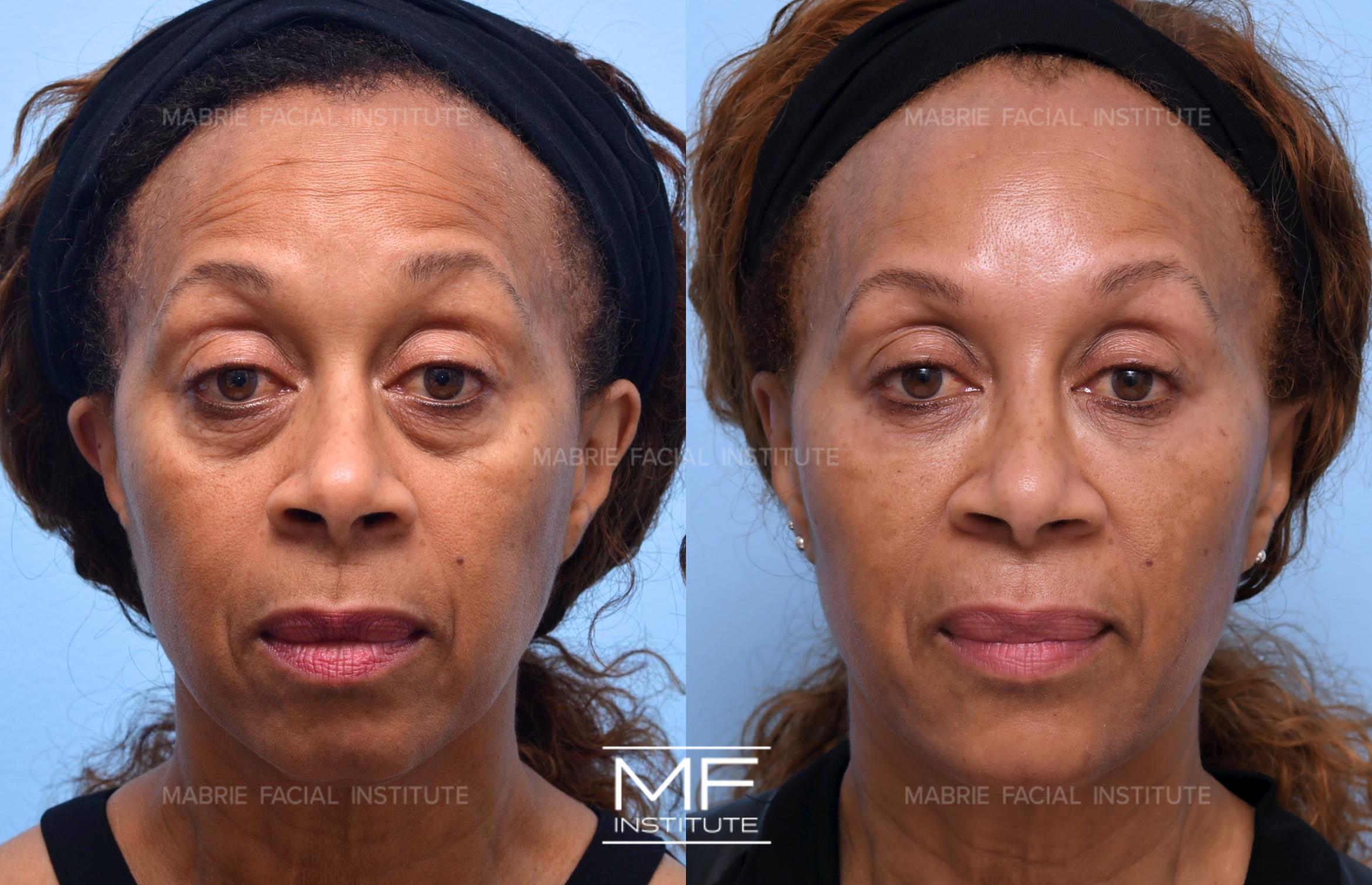 Before & After Under Eye Bags & Dark Circles Case 603 View #1 View in San Francisco, CA