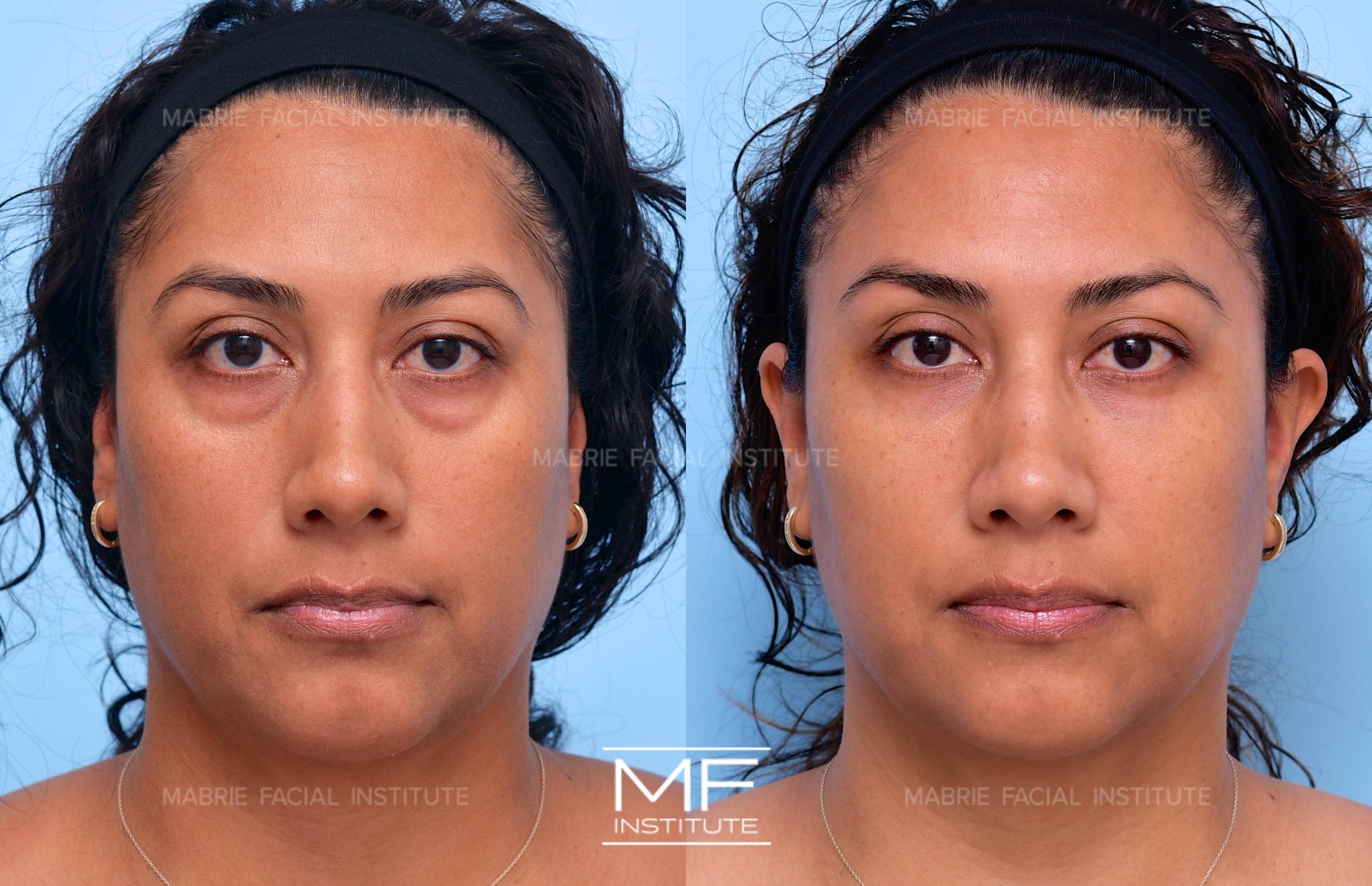 Before & After Under Eye Bags & Dark Circles Case 641 View #1 View in San Francisco, CA