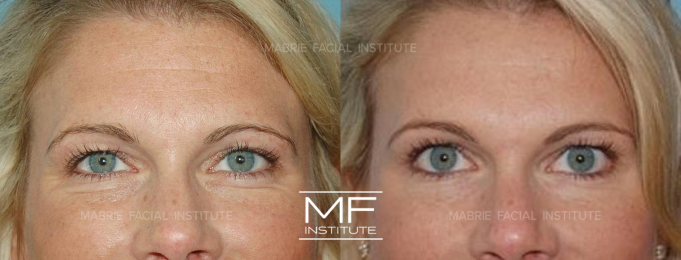 Before & After Under Eye Bulging Case 209 View #1 View in San Francisco, CA