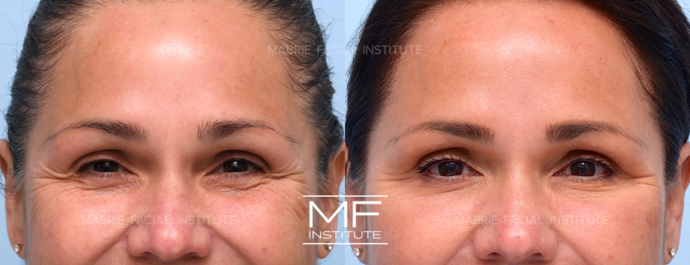 Before & After Under Eye Bulging Case 916 View #1 View in San Francisco, CA