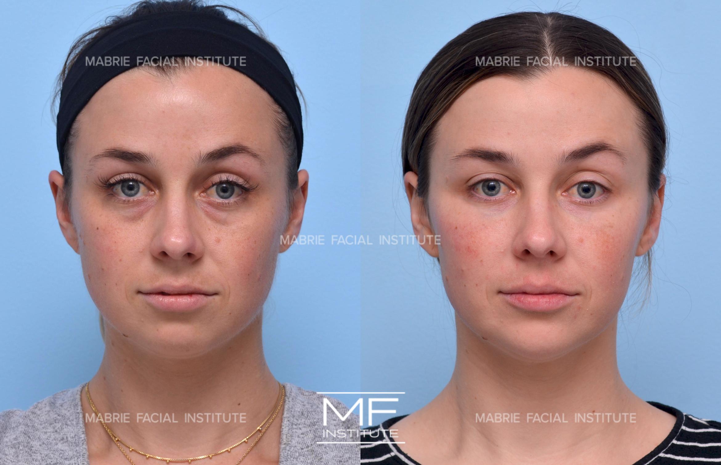 Before & After Under Eye Wrinkles Case 1295 Front View in San Francisco, CA